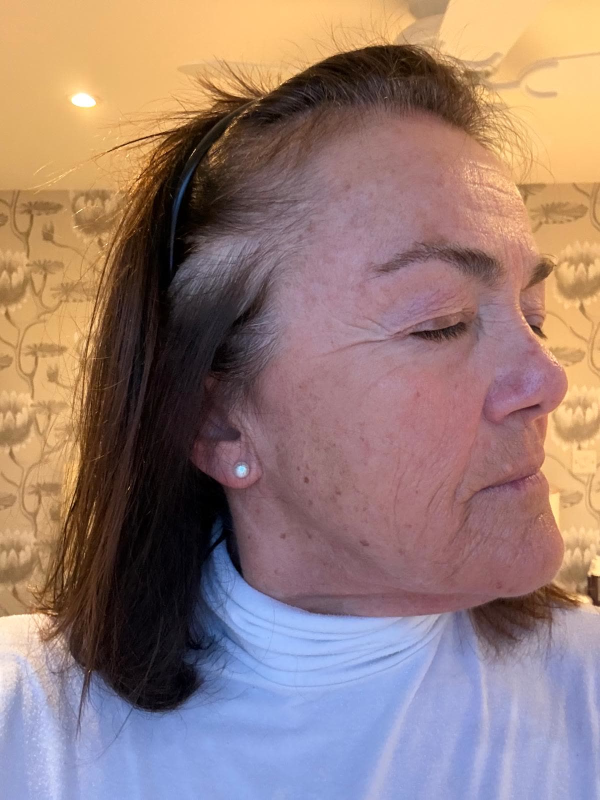 Origin Glass Laser anonymous full recovery journey Treatment 1 Day 13 recovery photo 4, showing full face, around the eyes, jawline and neck.
