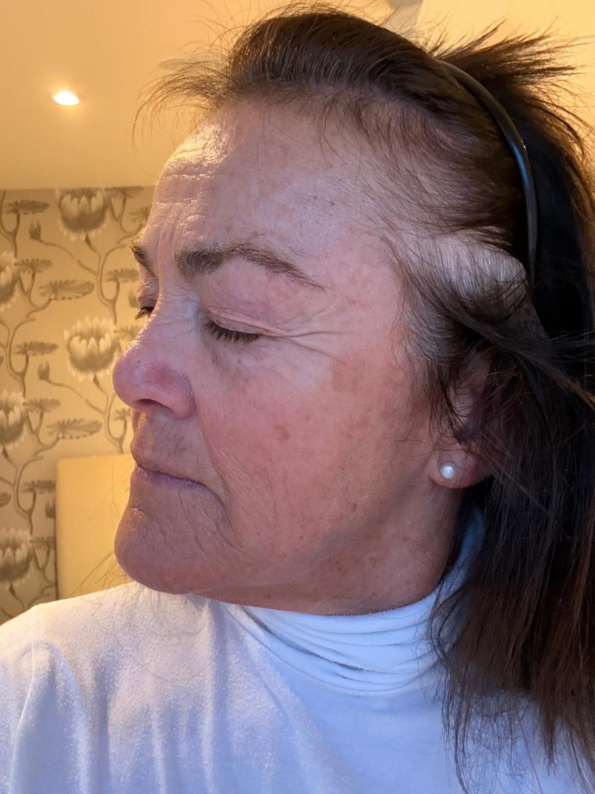 Origin Glass Laser anonymous full recovery journey Treatment 1 Day 13 recovery photo 5, showing full face, around the eyes, jawline and neck.