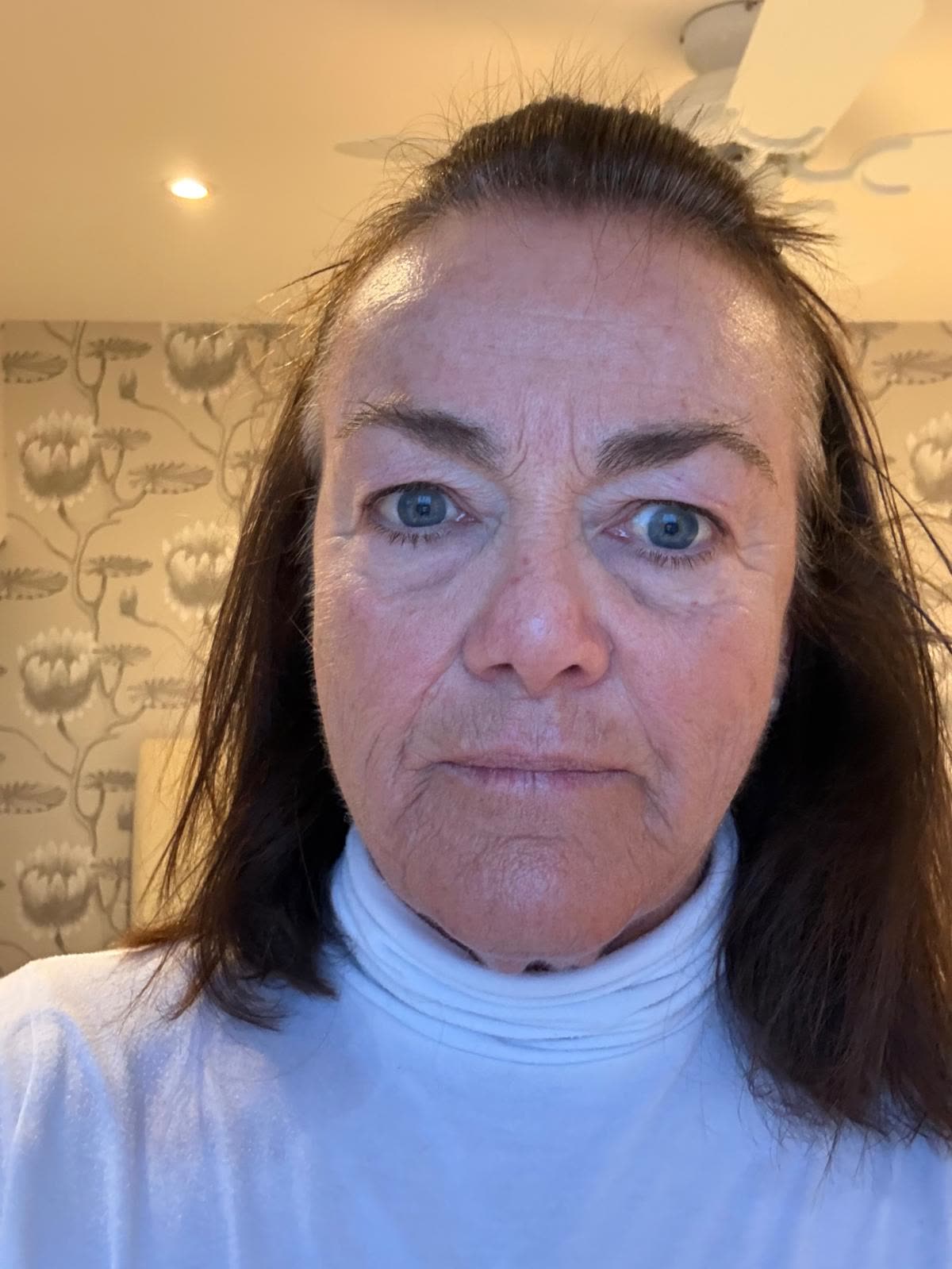 Origin Glass Laser anonymous full recovery journey Treatment 1 Day 13 recovery photo 6, showing full face, around the eyes, jawline and neck.