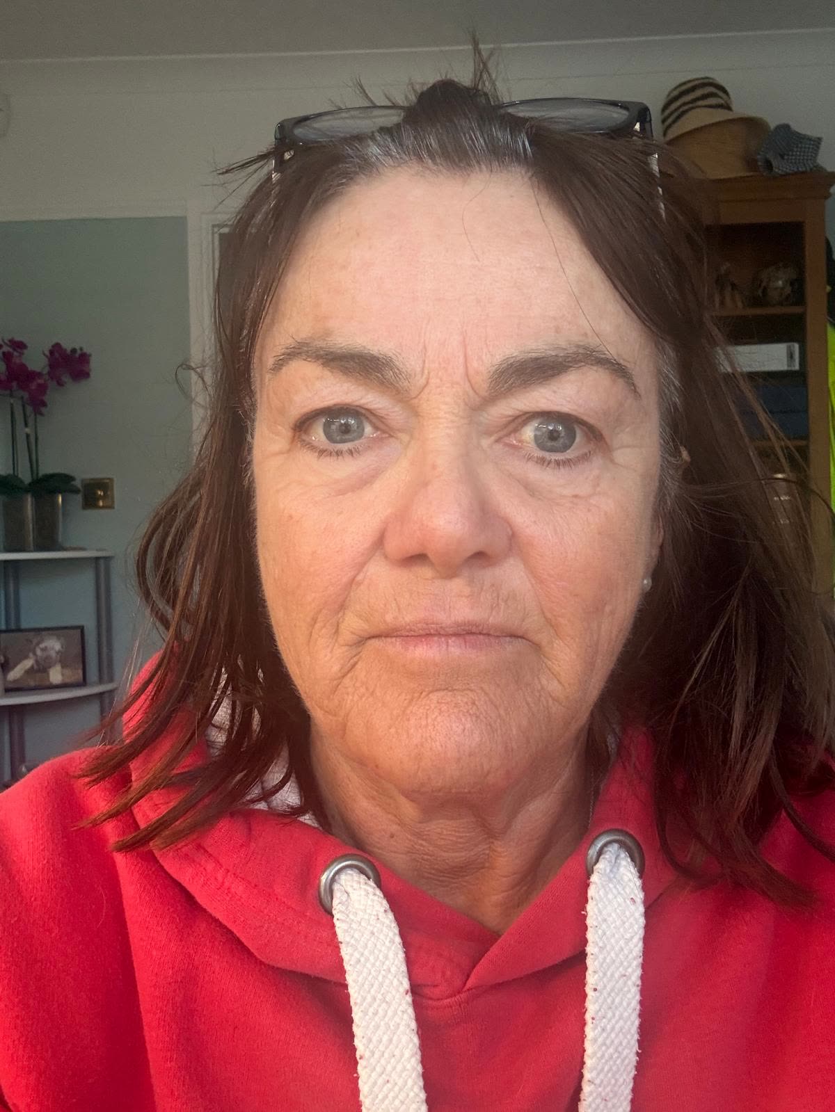 Origin Glass Laser anonymous full recovery journey Treatment 1 Day 16 recovery photo 1, showing full face, around the eyes, jawline and neck.
