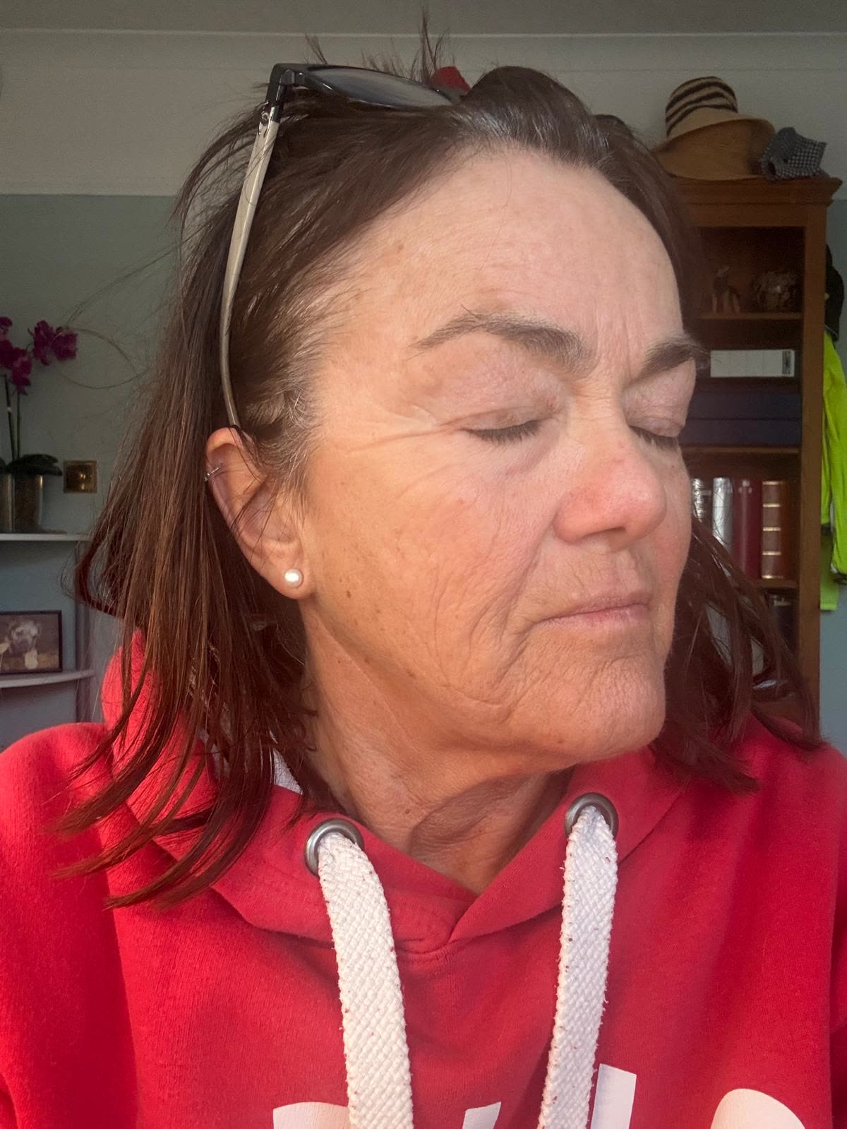 Origin Glass Laser anonymous full recovery journey Treatment 1 Day 16 recovery photo 3, showing full face, around the eyes, jawline and neck.