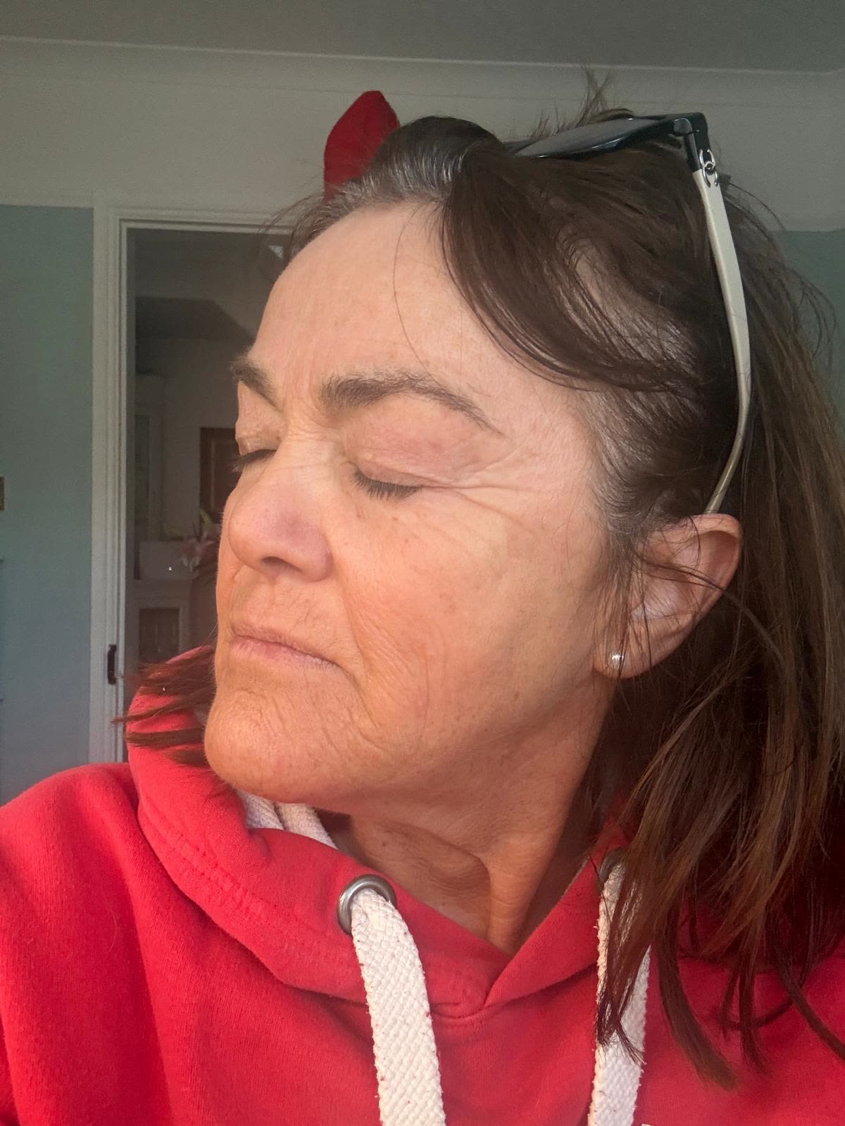 Origin Glass Laser anonymous full recovery journey Treatment 1 Day 16 recovery photo 4, showing full face, around the eyes, jawline and neck.