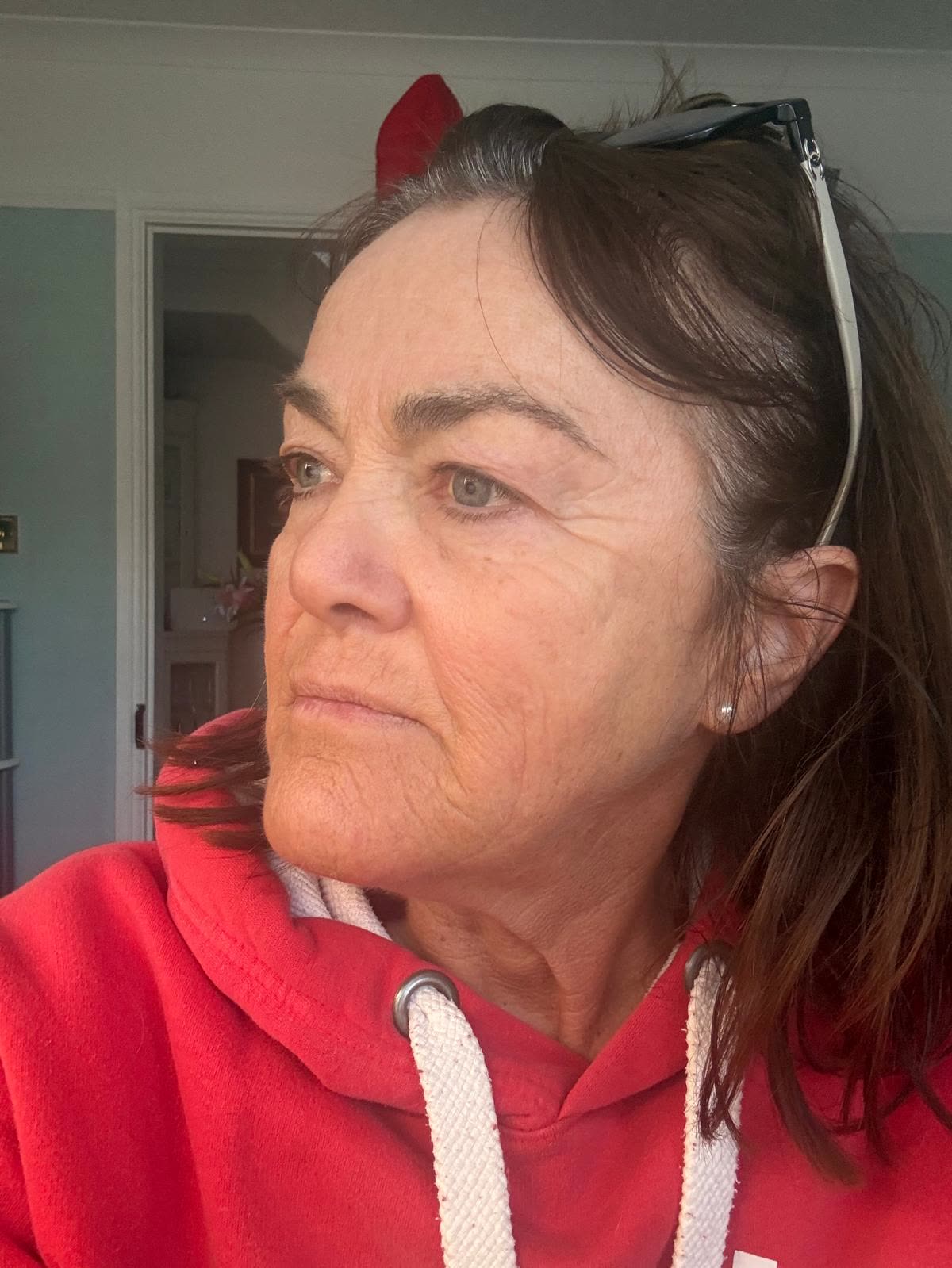 Origin Glass Laser anonymous full recovery journey Treatment 1 Day 16 recovery photo 5, showing full face, around the eyes, jawline and neck.