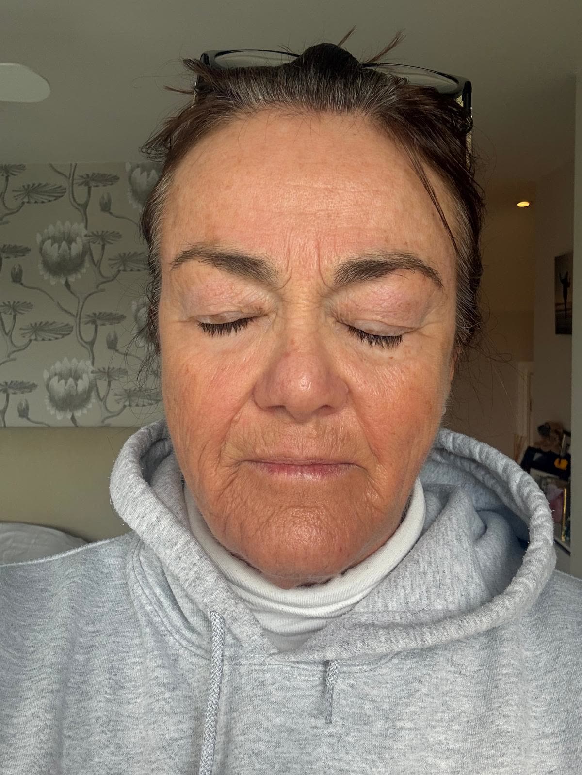 Origin Glass Laser anonymous full recovery journey Treatment 1 Day 19 recovery photo 1, showing full face, around the eyes, jawline and neck.