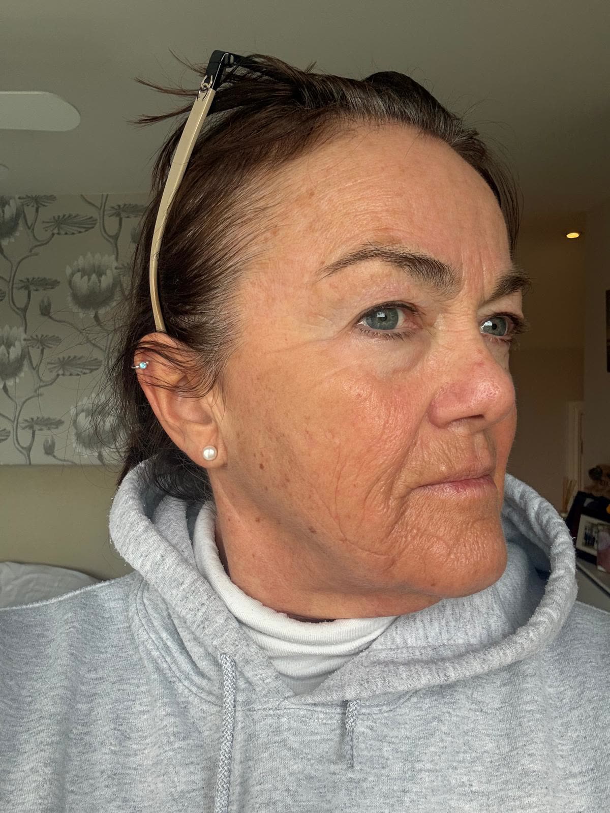 Origin Glass Laser anonymous full recovery journey Treatment 1 Day 19 recovery photo 2, showing full face, around the eyes, jawline and neck.