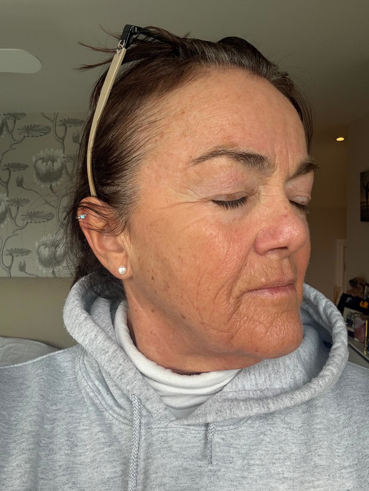 Origin Glass Laser anonymous full recovery journey Treatment 1 Day 19 recovery photo 3, showing full face, around the eyes, jawline and neck.