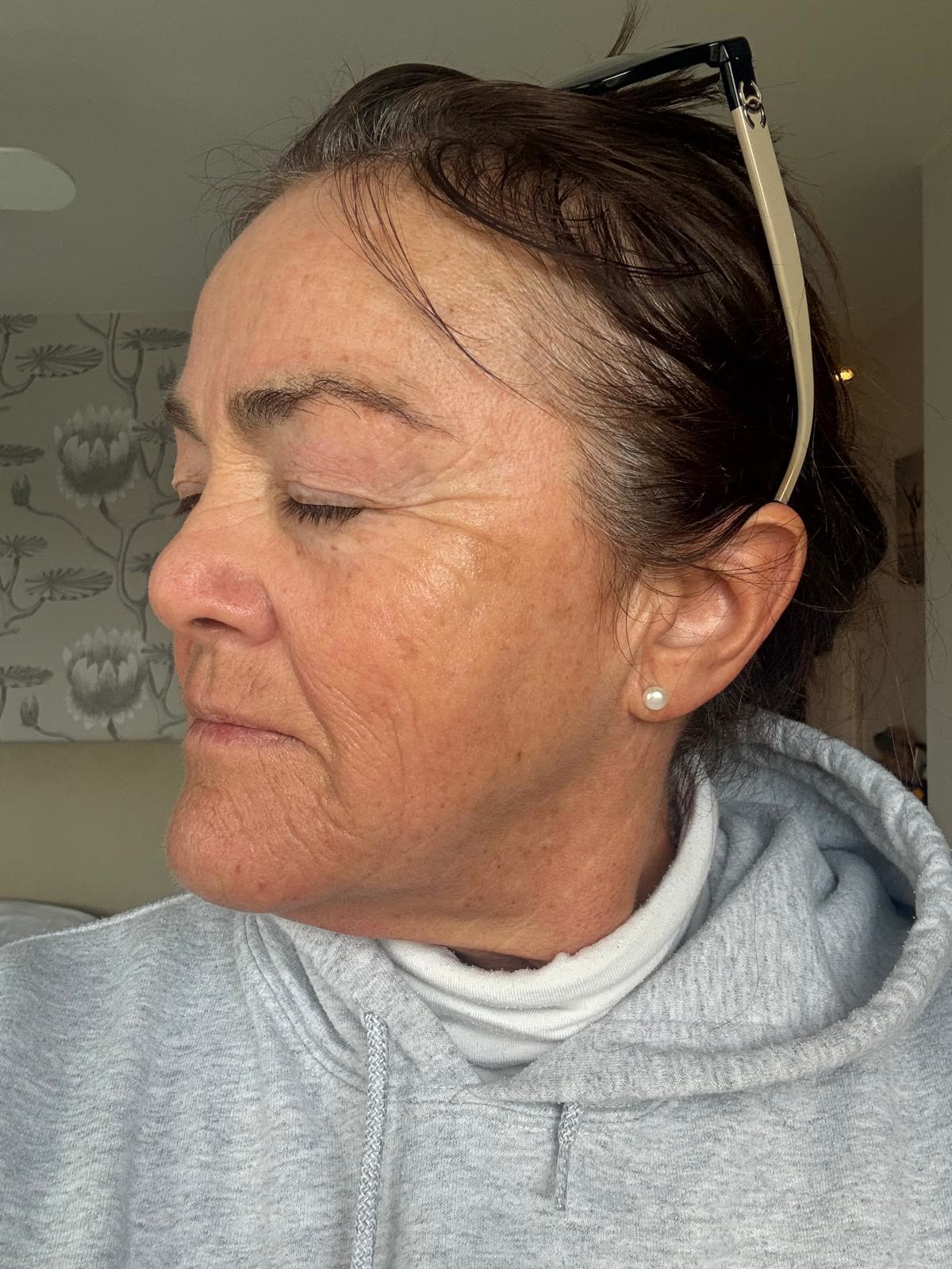 Origin Glass Laser anonymous full recovery journey Treatment 1 Day 19 recovery photo 4, showing full face, around the eyes, jawline and neck.