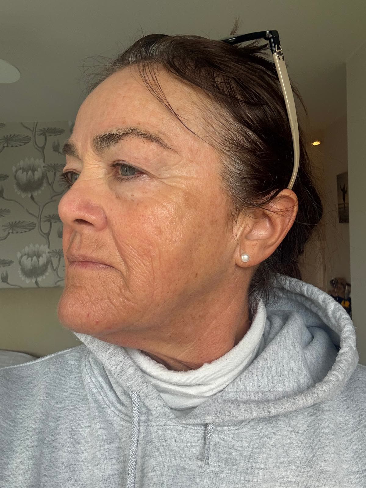 Origin Glass Laser anonymous full recovery journey Treatment 1 Day 19 recovery photo 5, showing full face, around the eyes, jawline and neck.