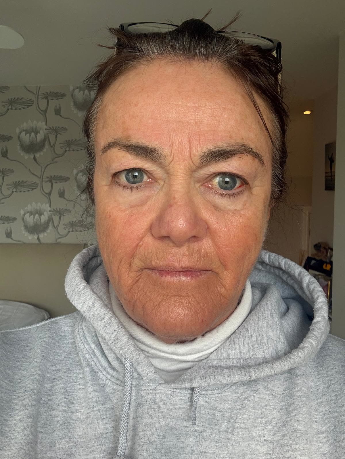 Origin Glass Laser anonymous full recovery journey Treatment 1 Day 19 recovery photo 6, showing full face, around the eyes, jawline and neck.