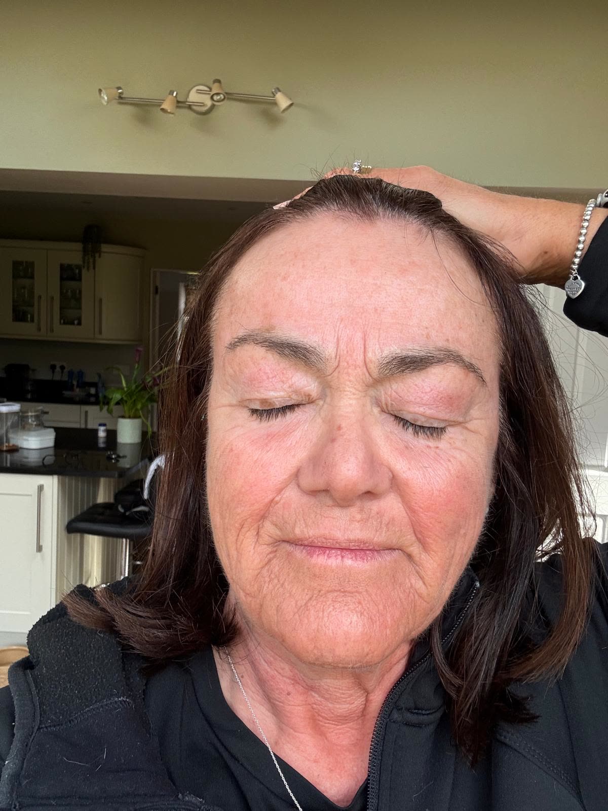 Origin Glass Laser anonymous full recovery journey Treatment 2 Day 2 recovery photo 1, showing full face, around the eyes, jawline and neck.