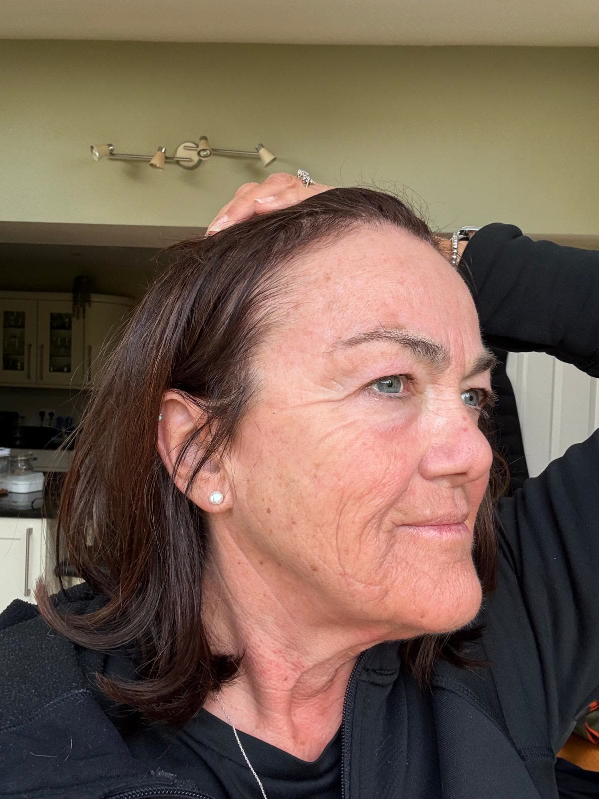 Origin Glass Laser anonymous full recovery journey Treatment 2 Day 2 recovery photo 2, showing full face, around the eyes, jawline and neck.