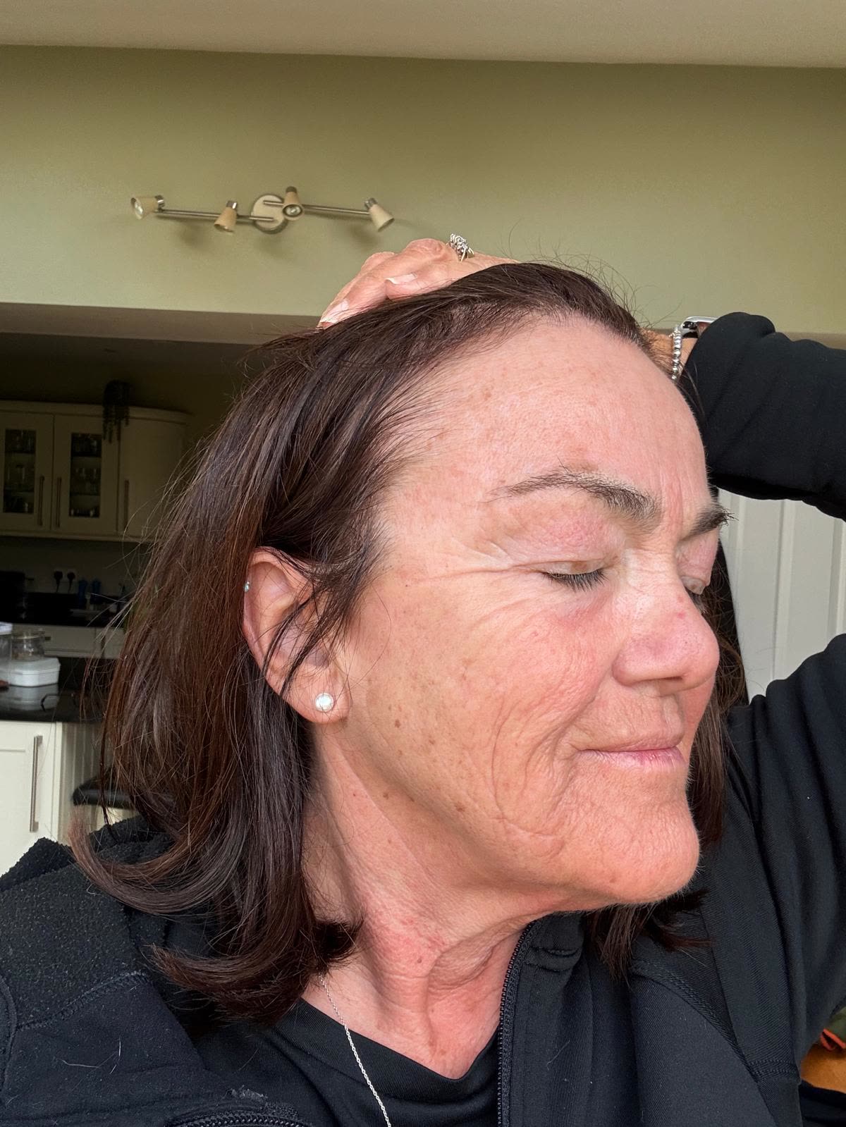 Origin Glass Laser anonymous full recovery journey Treatment 2 Day 2 recovery photo 3, showing full face, around the eyes, jawline and neck.