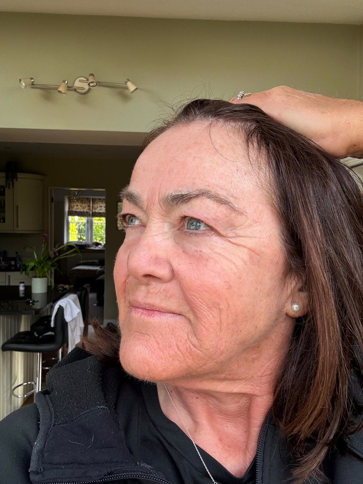 Origin Glass Laser anonymous full recovery journey Treatment 2 Day 2 recovery photo 4, showing full face, around the eyes, jawline and neck.