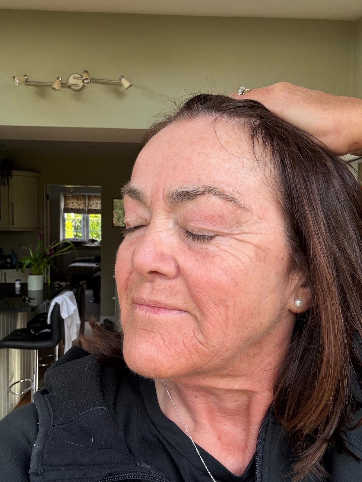 Origin Glass Laser anonymous full recovery journey Treatment 2 Day 2 recovery photo 5, showing full face, around the eyes, jawline and neck.