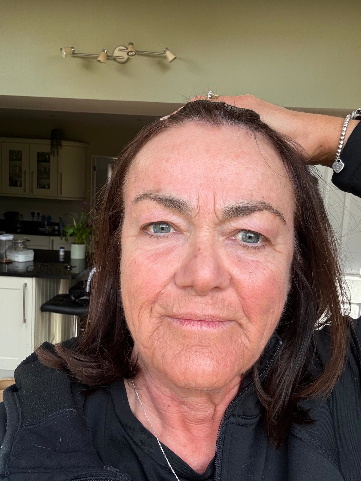Origin Glass Laser anonymous full recovery journey Treatment 2 Day 2 recovery photo 6, showing full face, around the eyes, jawline and neck.