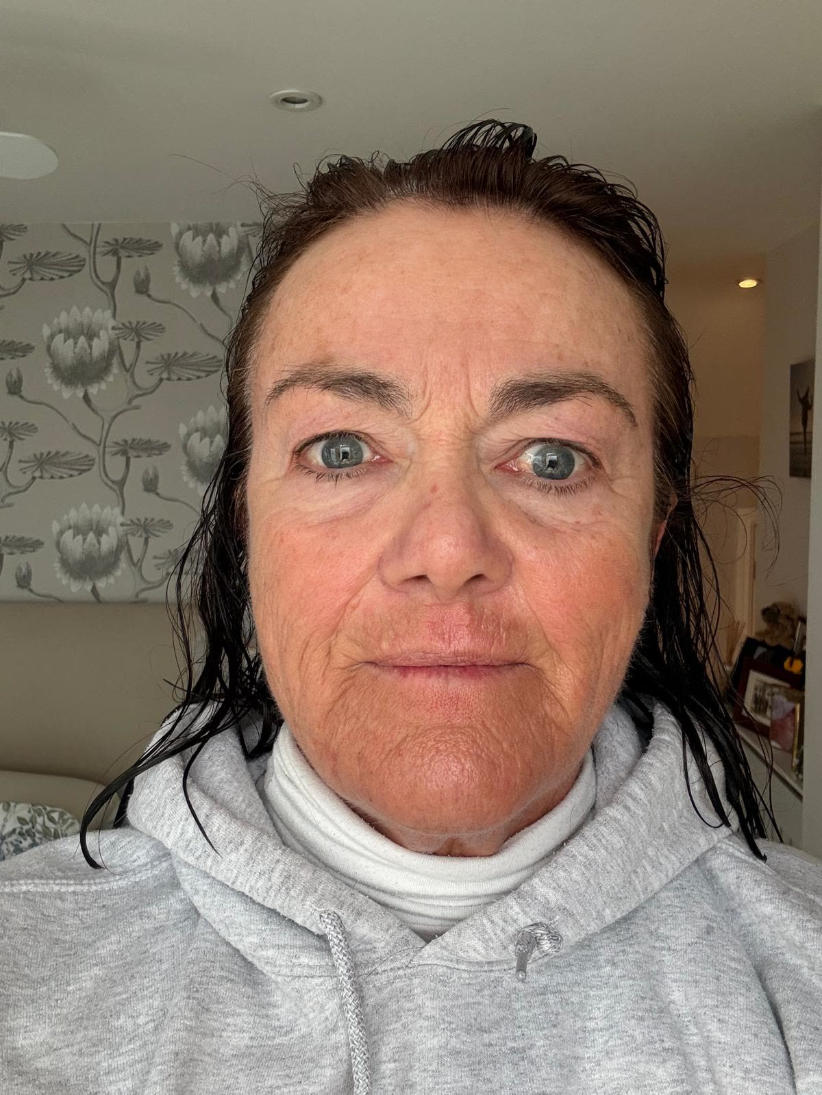 Origin Glass Laser anonymous full recovery journey Treatment 2 Day 5 recovery photo 1, showing full face, around the eyes, jawline and neck.