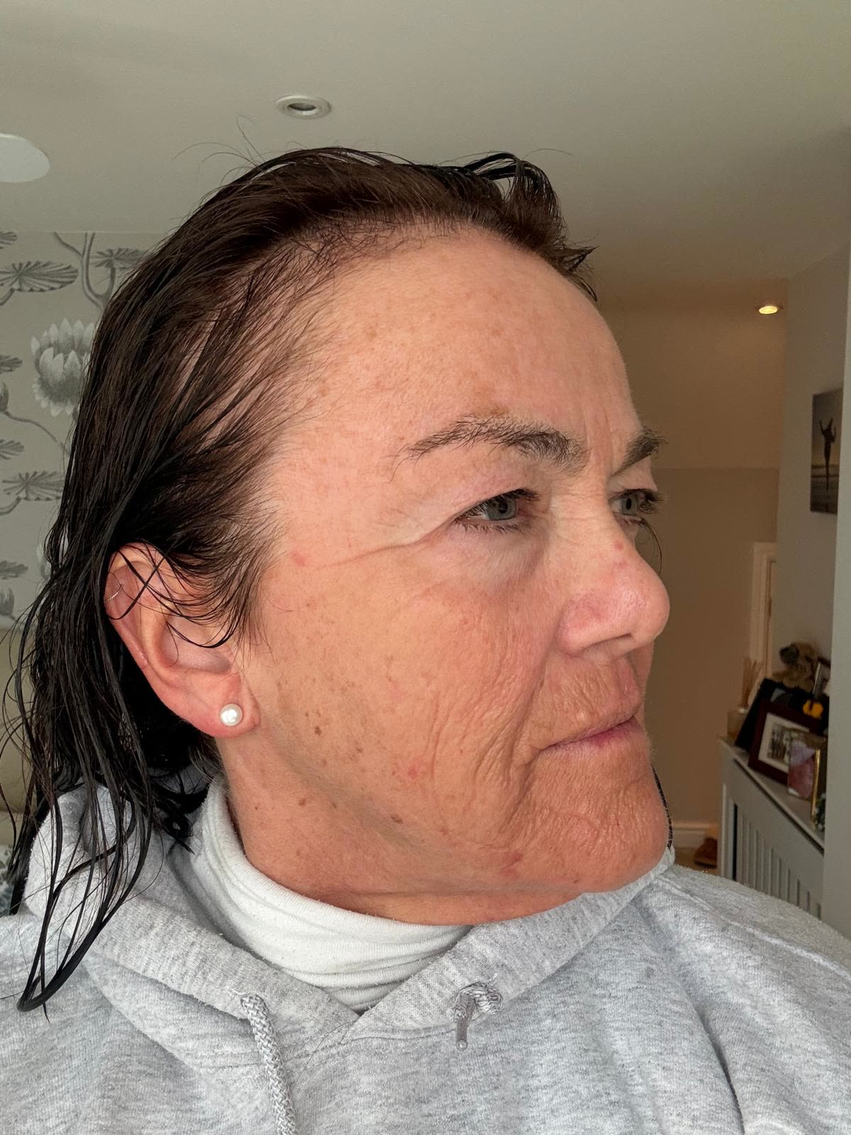Origin Glass Laser anonymous full recovery journey Treatment 2 Day 5 recovery photo 2, showing full face, around the eyes, jawline and neck.
