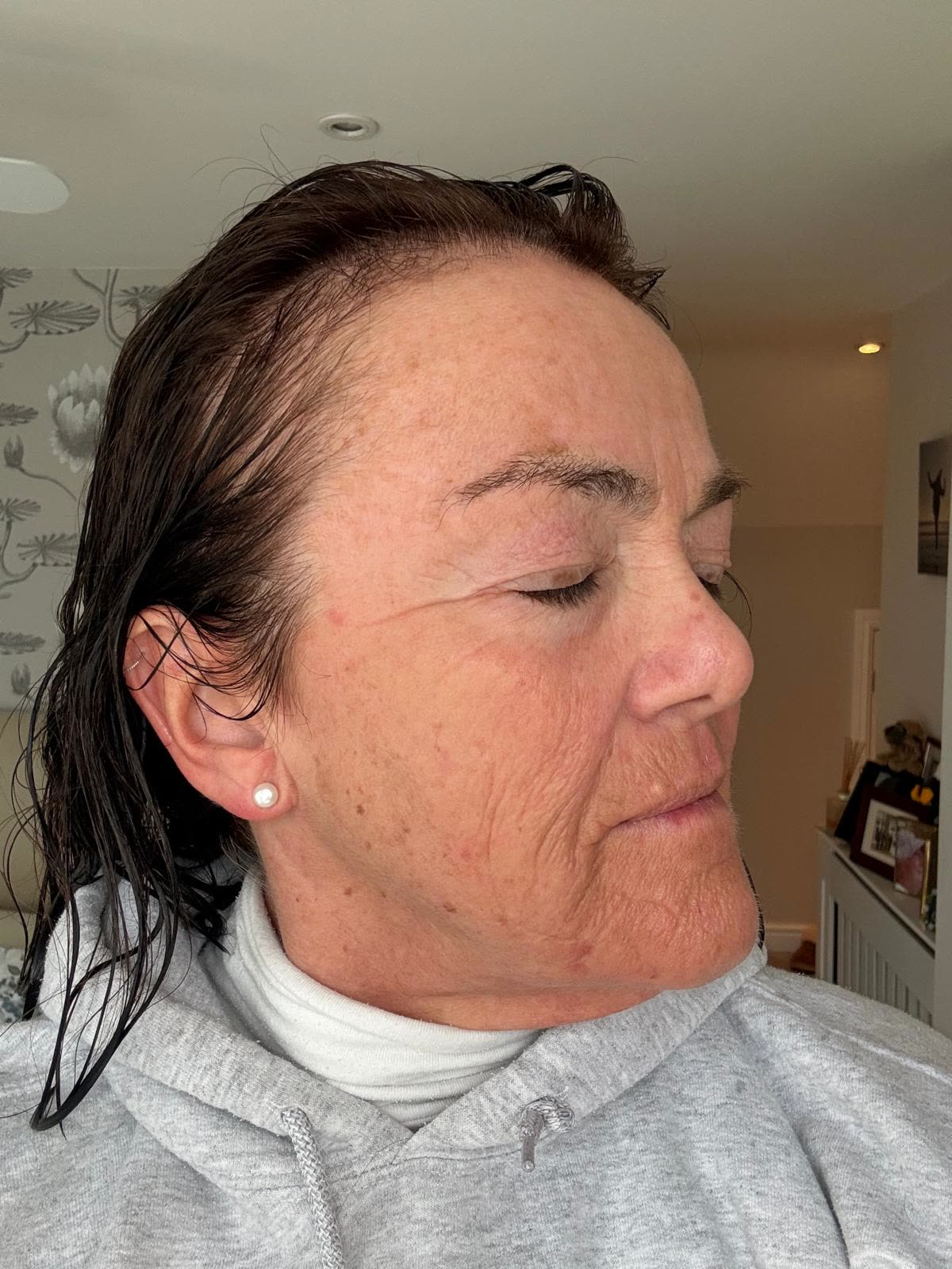 Origin Glass Laser anonymous full recovery journey Treatment 2 Day 5 recovery photo 3, showing full face, around the eyes, jawline and neck.