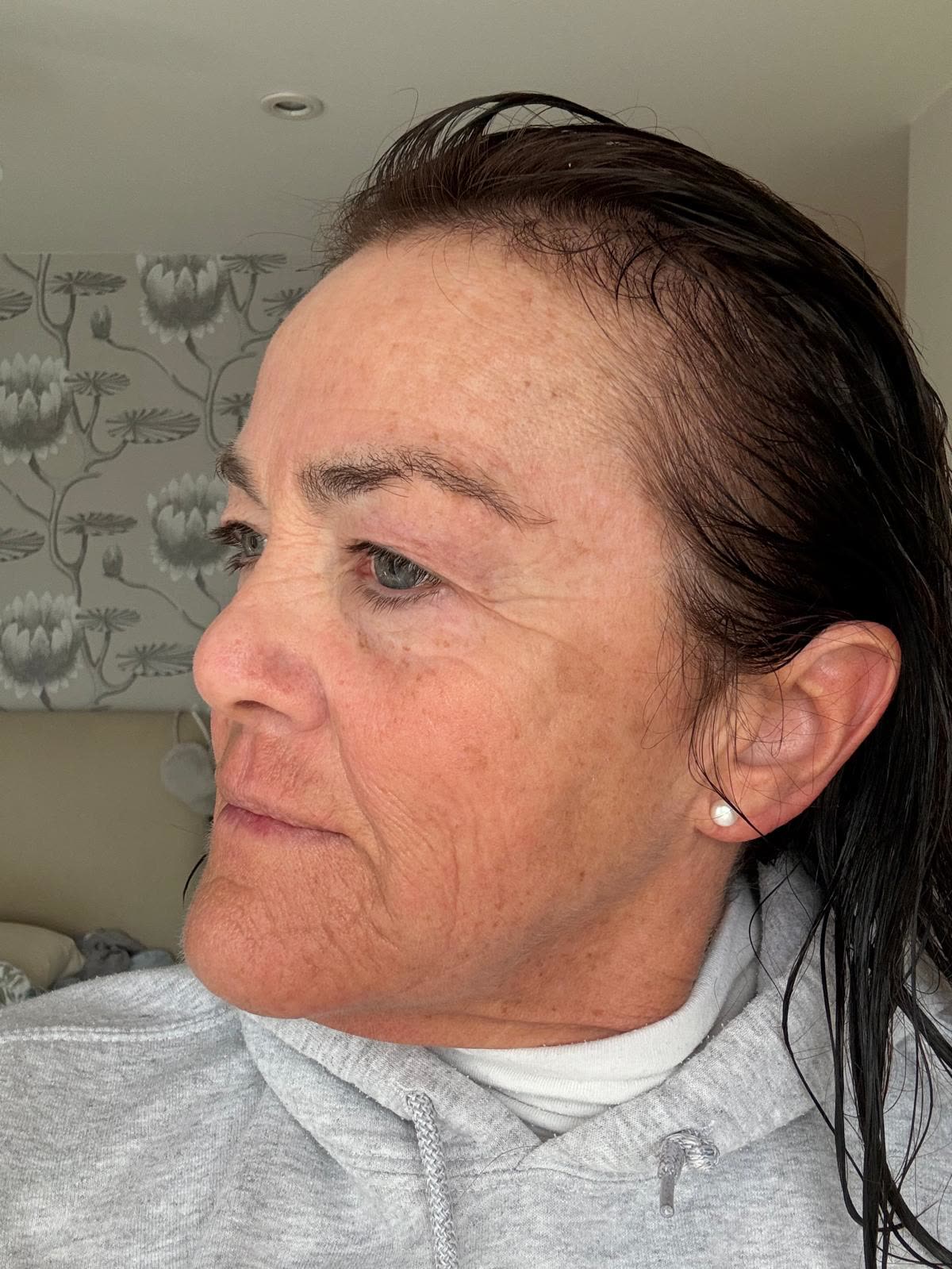 Origin Glass Laser anonymous full recovery journey Treatment 2 Day 5 recovery photo 4, showing full face, around the eyes, jawline and neck.