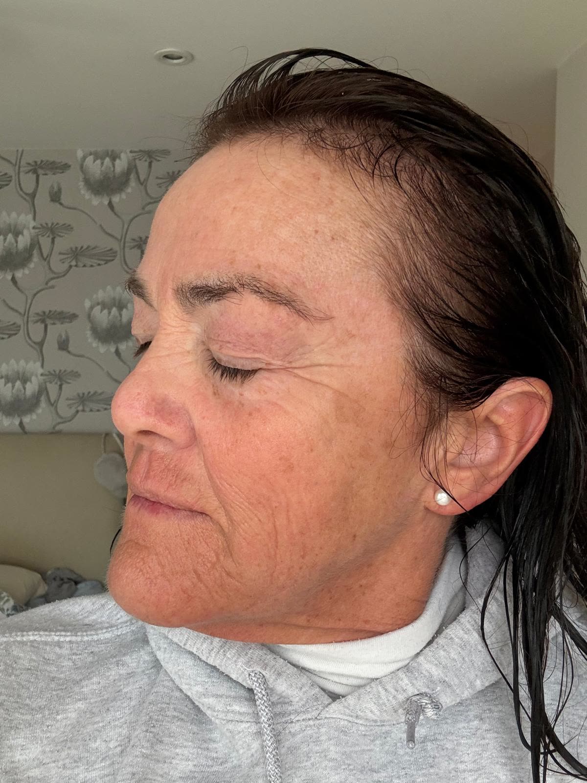 Origin Glass Laser anonymous full recovery journey Treatment 2 Day 5 recovery photo 5, showing full face, around the eyes, jawline and neck.