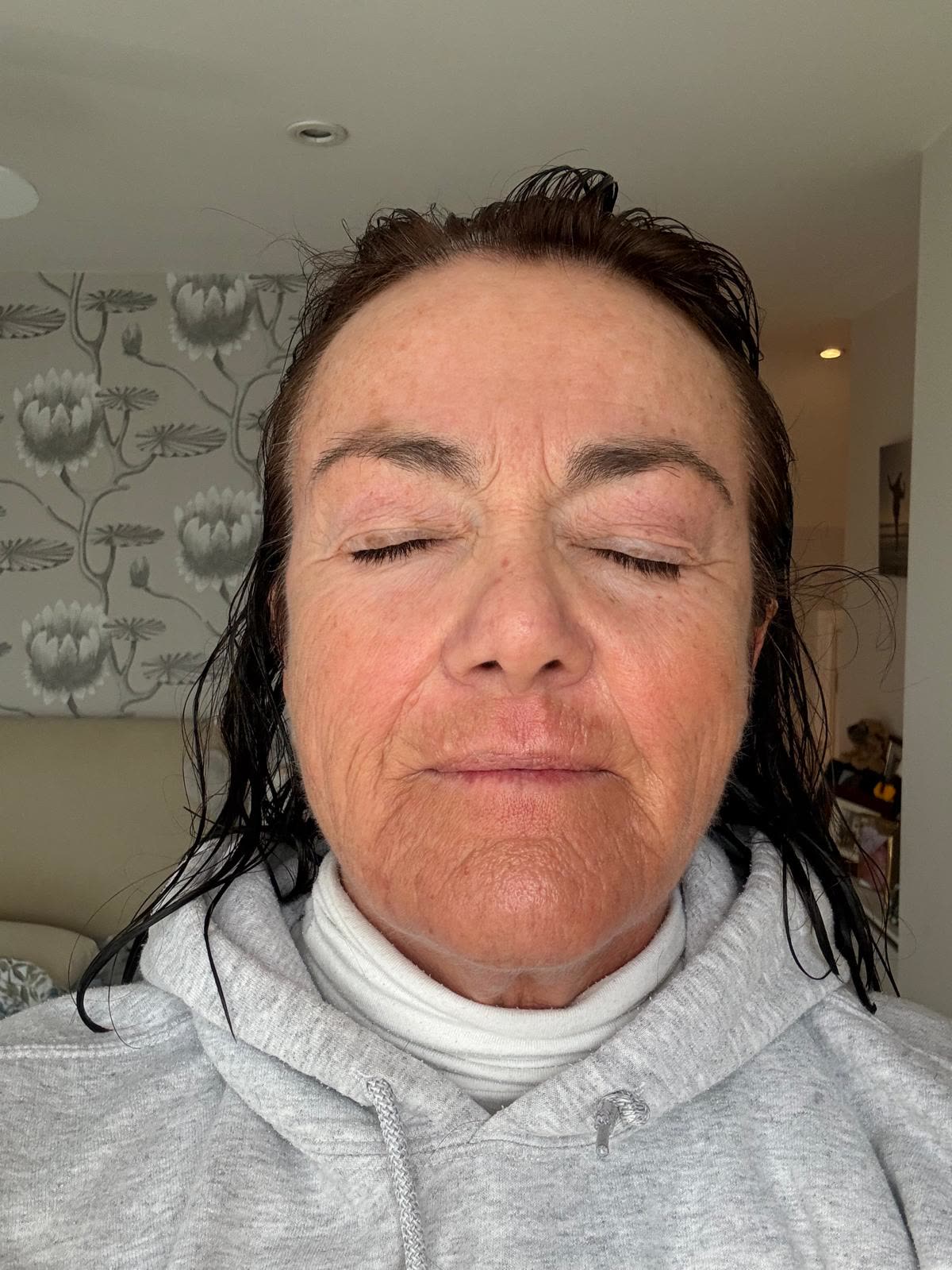 Origin Glass Laser anonymous full recovery journey Treatment 2 Day 5 recovery photo 6, showing full face, around the eyes, jawline and neck.