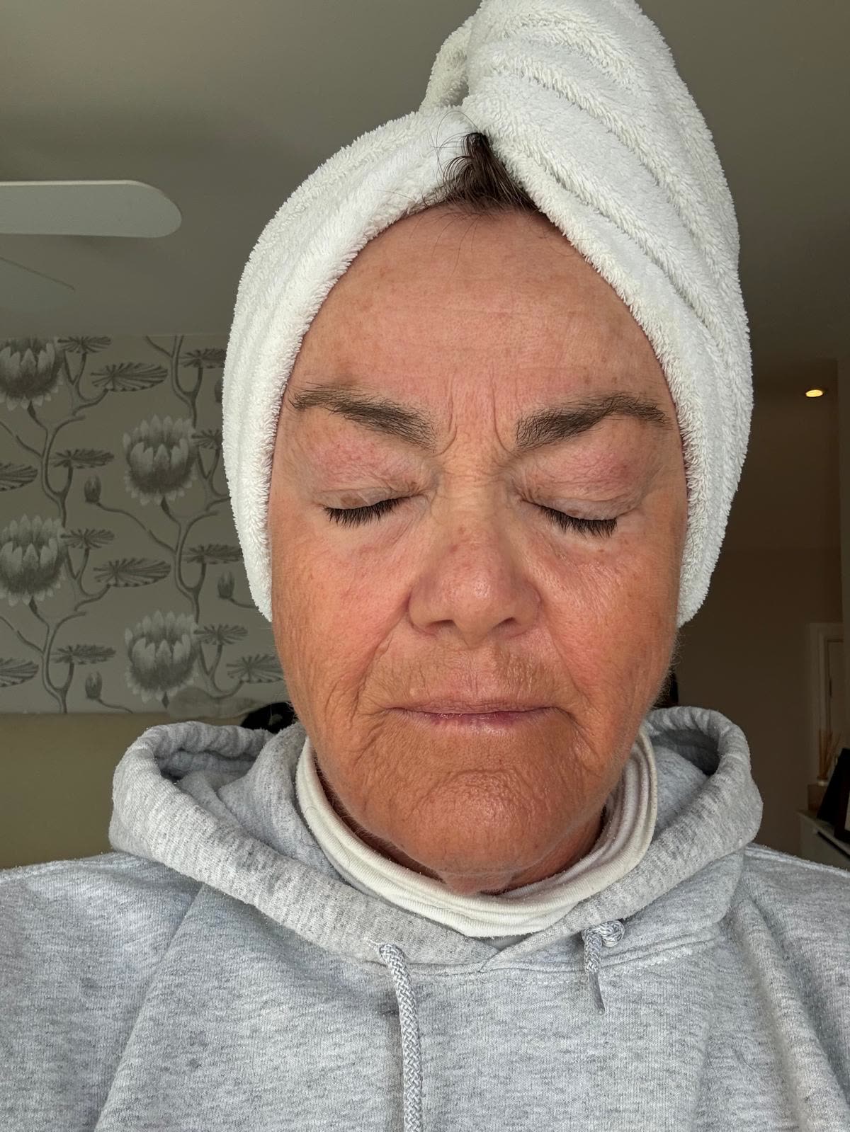 Origin Glass Laser anonymous full recovery journey Treatment 2 Day 28 recovery photo 1, showing full face, around the eyes, jawline and neck.