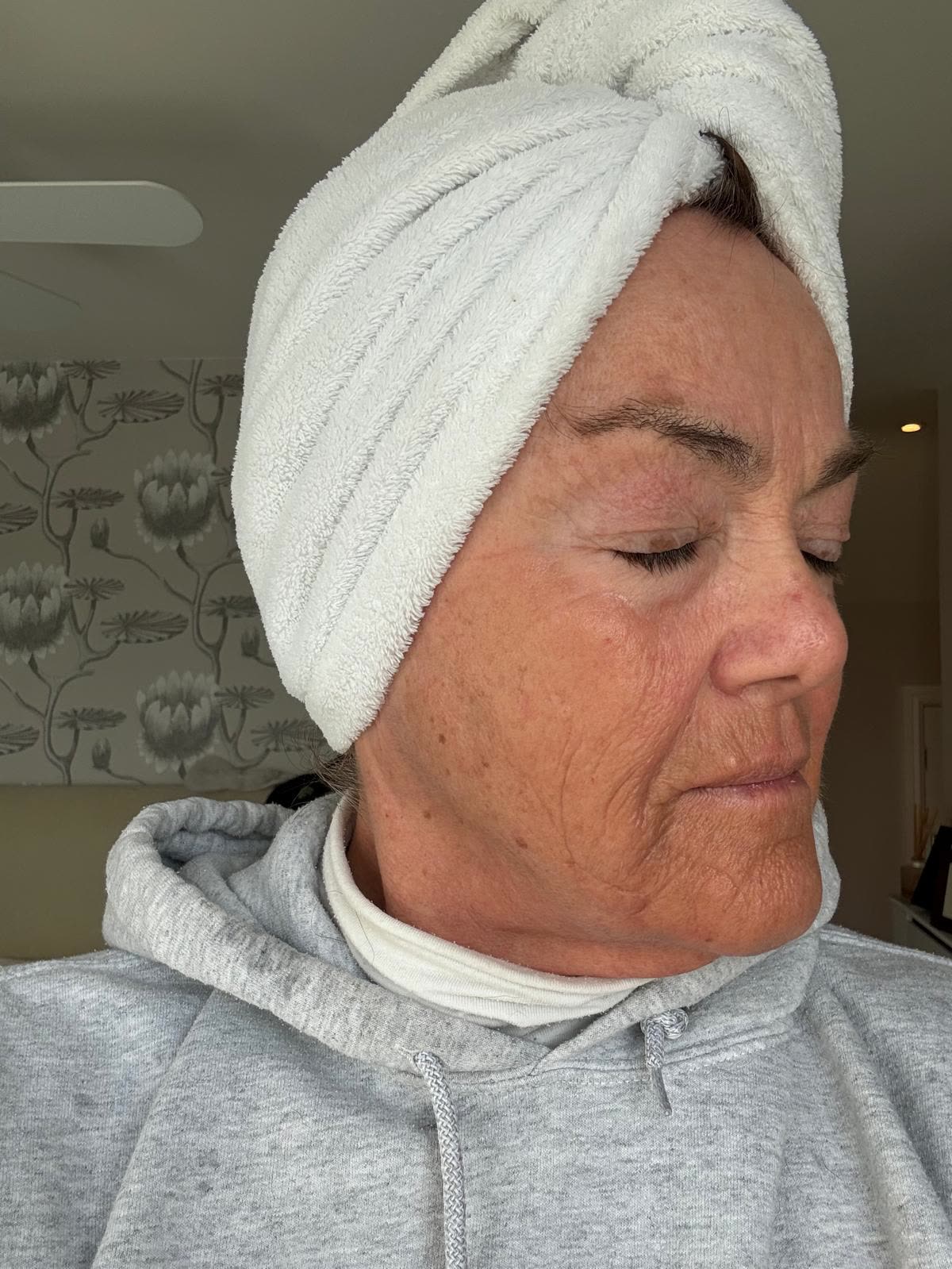 Origin Glass Laser anonymous full recovery journey Treatment 2 Day 28 recovery photo 3, showing full face, around the eyes, jawline and neck.