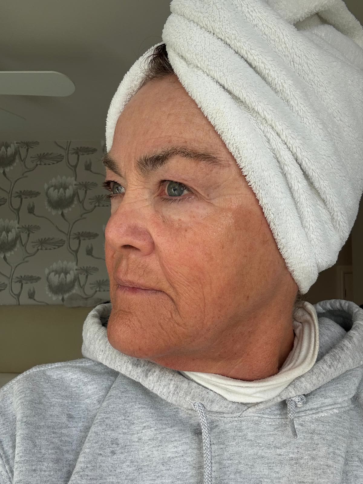 Origin Glass Laser anonymous full recovery journey Treatment 2 Day 28 recovery photo 4, showing full face, around the eyes, jawline and neck.