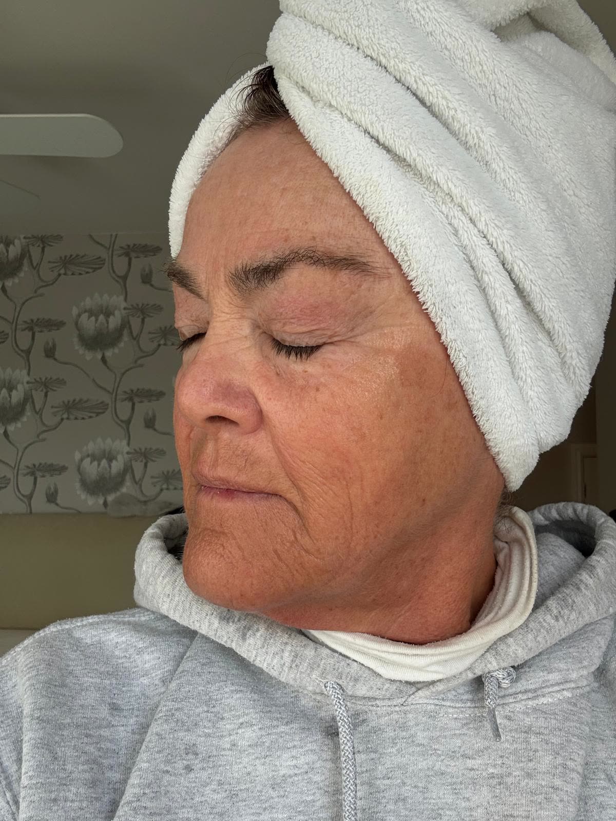 Origin Glass Laser anonymous full recovery journey Treatment 2 Day 28 recovery photo 5, showing full face, around the eyes, jawline and neck.