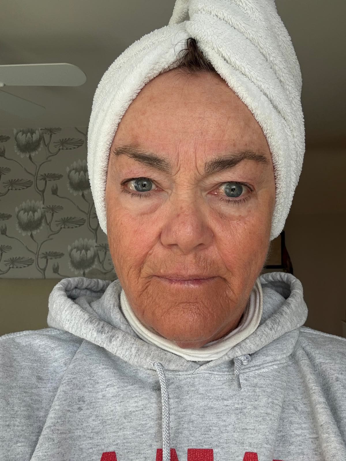 Origin Glass Laser anonymous full recovery journey Treatment 2 Day 28 recovery photo 6, showing full face, around the eyes, jawline and neck.