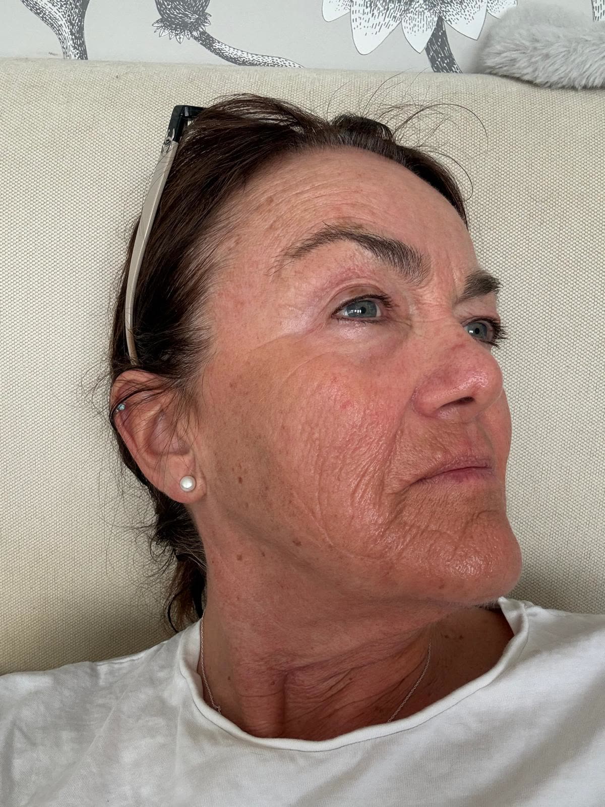 Origin Glass Laser anonymous full recovery journey Treatment 3 Day 7 recovery photo 2, showing full face, around the eyes, jawline and neck.