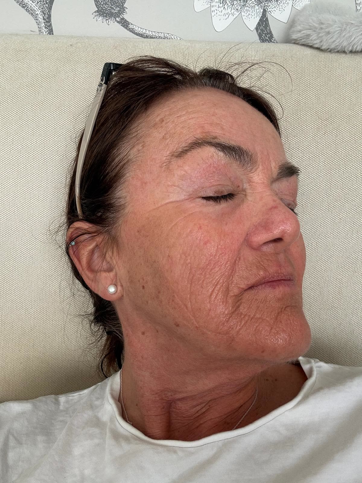 Origin Glass Laser anonymous full recovery journey Treatment 3 Day 7 recovery photo 3, showing full face, around the eyes, jawline and neck.