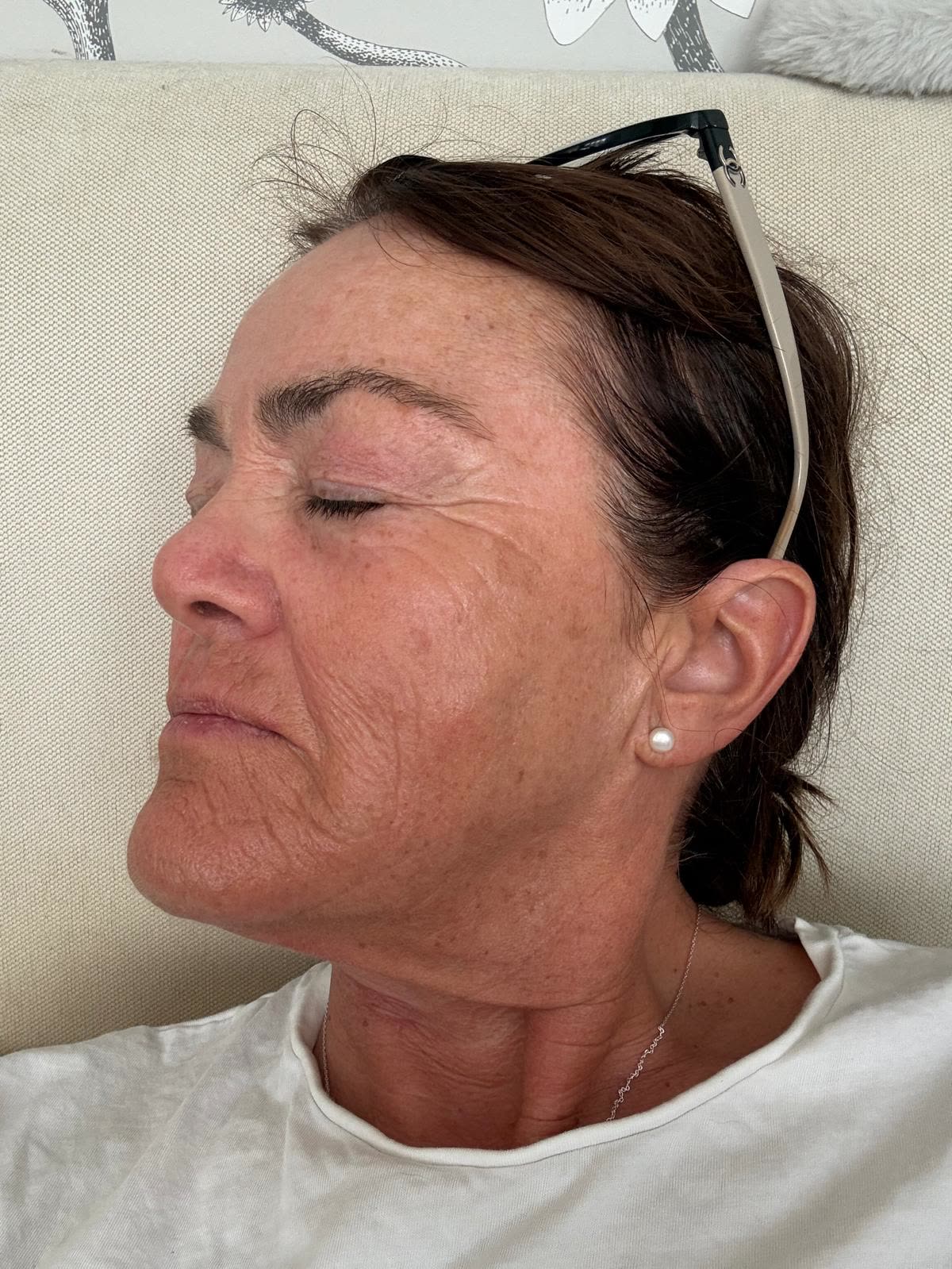 Origin Glass Laser anonymous full recovery journey Treatment 3 Day 7 recovery photo 4, showing full face, around the eyes, jawline and neck.