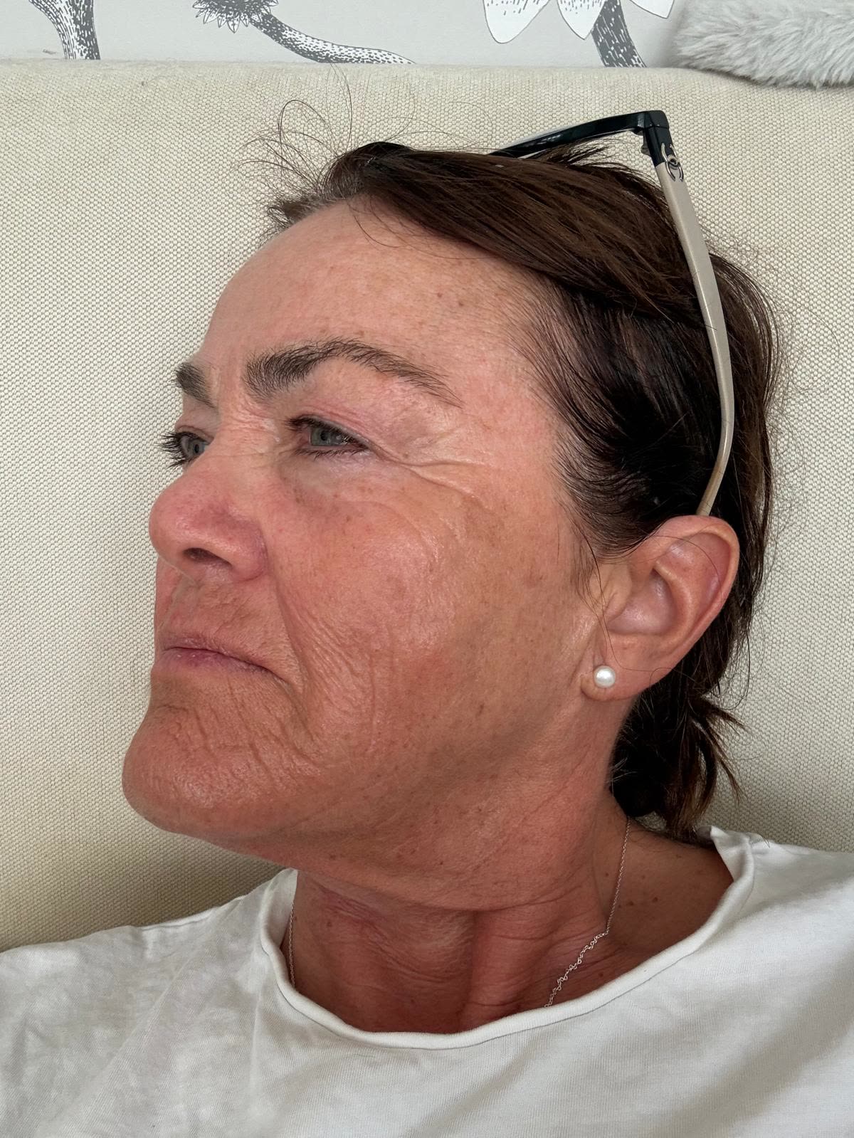 Origin Glass Laser anonymous full recovery journey Treatment 3 Day 7 recovery photo 5, showing full face, around the eyes, jawline and neck.