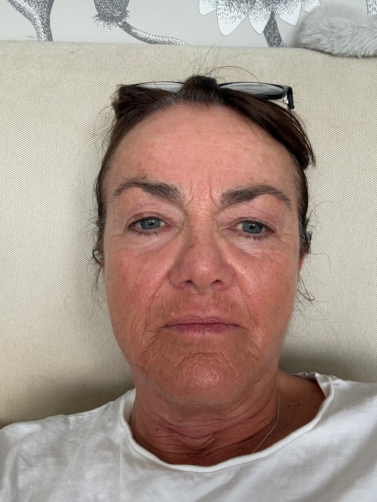 Origin Glass Laser anonymous full recovery journey Treatment 3 Day 7 recovery photo 6, showing full face, around the eyes, jawline and neck.