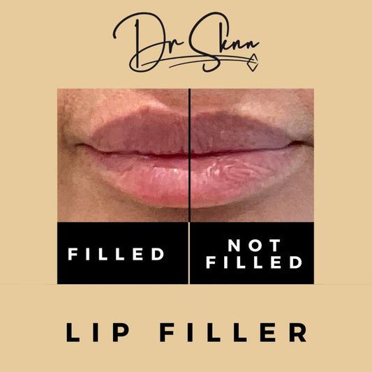 Lip Fillers in Wilmslow