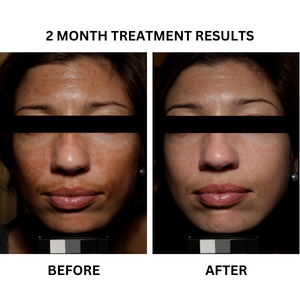 Before and after photographs from the existing "Pigmentation Rescue" - A Prescription Package of Medical Grade Skincare to treat Pigmentation banner.