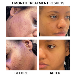 Before and after photographs from the existing "ClearSkinRx" - A Prescription Package of Medical Grade Acne Skincare Treatment banner.