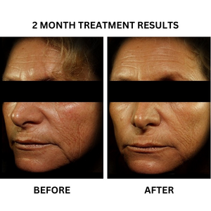 Before and after photographs from the existing "Radiance Boost" - A Prescription Package of Medical Grade Skincare for Radiant & Glowing Skin banner.
