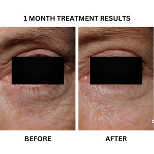 Before and after photographs from the existing "Radiant Eyes" - A Prescription Package of Medical Grade Skincare Treatment for Under-eye Pigmentation, Wrinkles & Fine Lines banner.