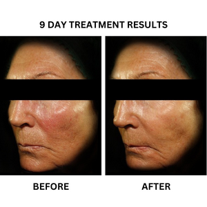Before and after photographs from the existing "Redness Relief" - A Prescription Package of Medical Grade Skincare to treat Redness banner.