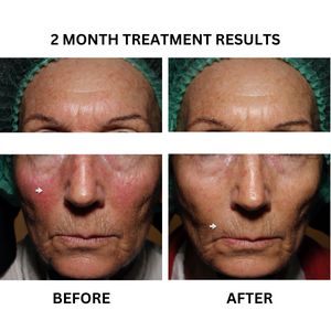 Before and after photographs from the existing "Rosacea Relief" - A Prescription Package of Medical Grade Skincare to treat Rosacea banner.