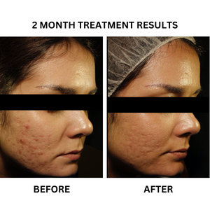 Before and after photographs from the existing "Scar Erase" - A Prescription Package of Medical Grade Skincare to Reverse Skin Scarring banner.
