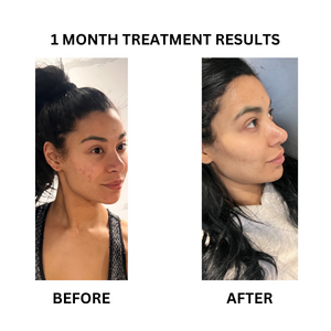 Before and after photographs from the existing "SknnClear" - A Prescription Package of Medical Grade Skincare for Clear Complexion banner.