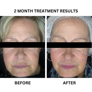 Before and after photographs from the existing "Texture Perfect" - A Prescription Package of Medical Grade Skincare to treat Skin Texture banner.