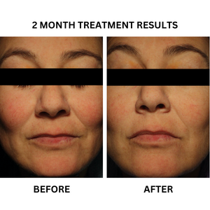 Before and after photographs from the existing "Vascular Vein Therapy" - A Prescription Package of Medical Grade Skincare Treatment to Treat Thread Veins banner.