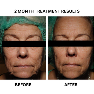 Before and after photographs from the existing "YouthRevive" - A Personalised Skincare Treatment Package to Rejuvenate Skin Elasticity and Reduce Sagging banner.
