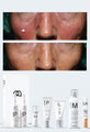 Personalised Medical Grade Prescription Skincare Treatment for Rosacea complete package