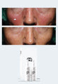 Prescription Medical Grade Rosacea Skincare Treatment