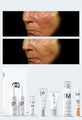 Personalised Medical Grade Prescription Skincare Treatment for Skin Redness complete package